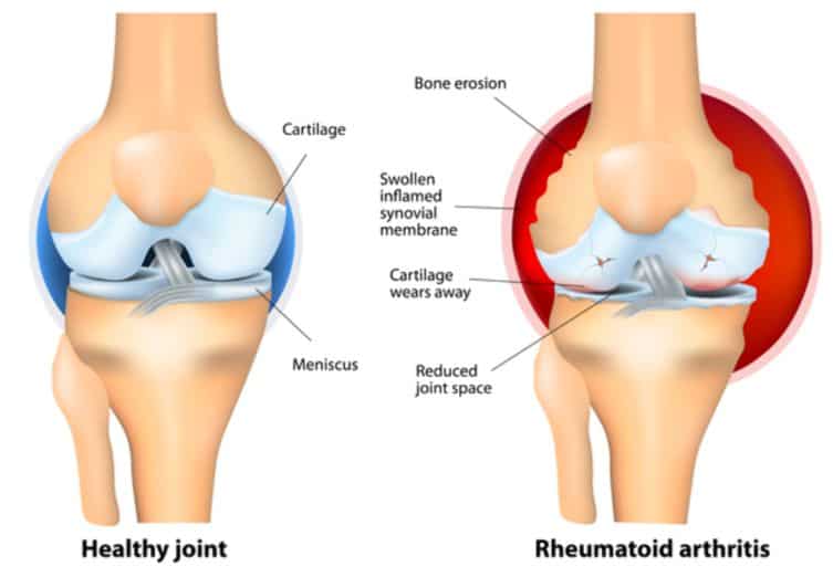 picture showing healthy joint and joint with arthritis